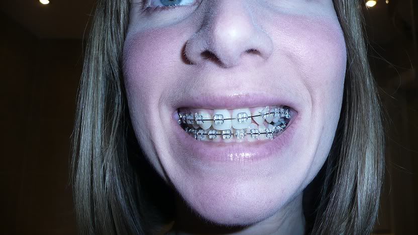 Mouth Full Of Braces 57